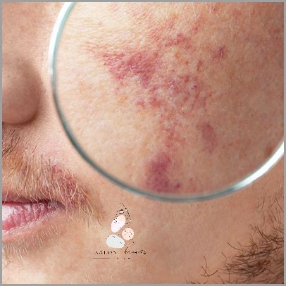 Cera naczynkowa – jak pielęgnować wrażliwą skórę z rumieniem